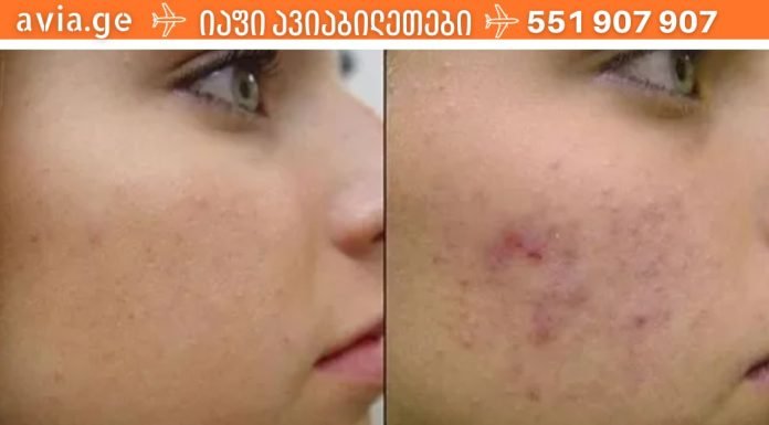 აკნეს ( პროჩიკების ) ყველაზე ეფექტური საშუალება!