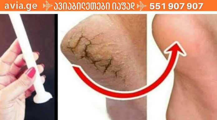 როგორ მოვიშოროთ დაბზარული ქუსლები